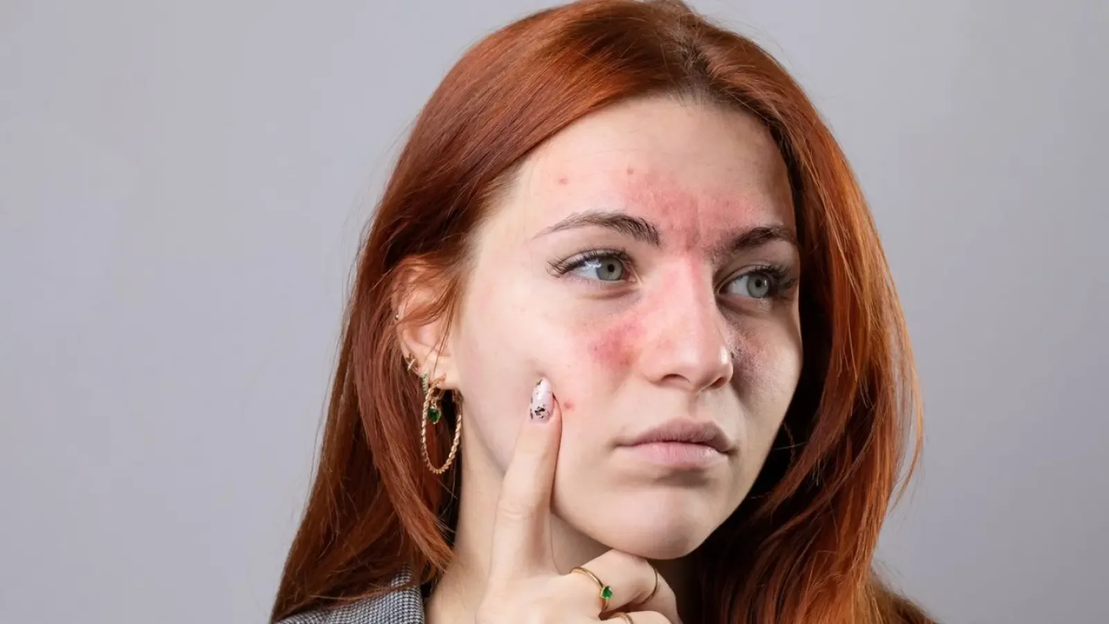 5 кожни симптома, при които не бива да отлагате дерматолог